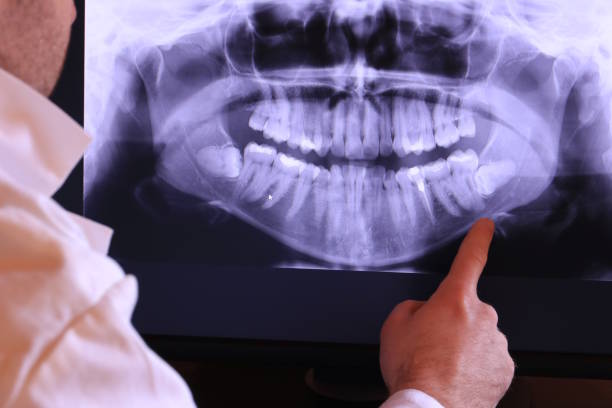 Best Emergency Wisdom Teeth Removal in Clifton, TN